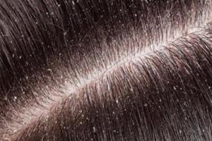 ਸਿਕਰੀ ਦੀ ਸਮੱਸਿਆ ਖ਼ਤਮ ਕਰਨ ਲਈ ਘਰੇਲੂ ਨੁਸਖ਼ ,ਲੋਕਾਂ ਨੂੰ ਕਈ ਵਾਰ ਸ਼ਰਮਿੰਦਗੀ ਦਾ ਸਾਹਮਣਾ ਵੀ ਕਰਨਾ ਪੈਂਦਾ ਹੈ